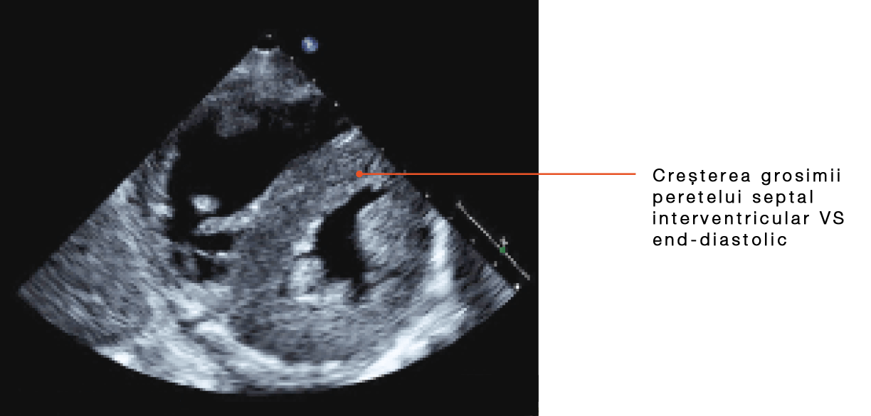 parasternal-short-axis